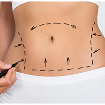 full tummy tuck