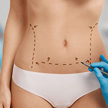 mini tummy tuck