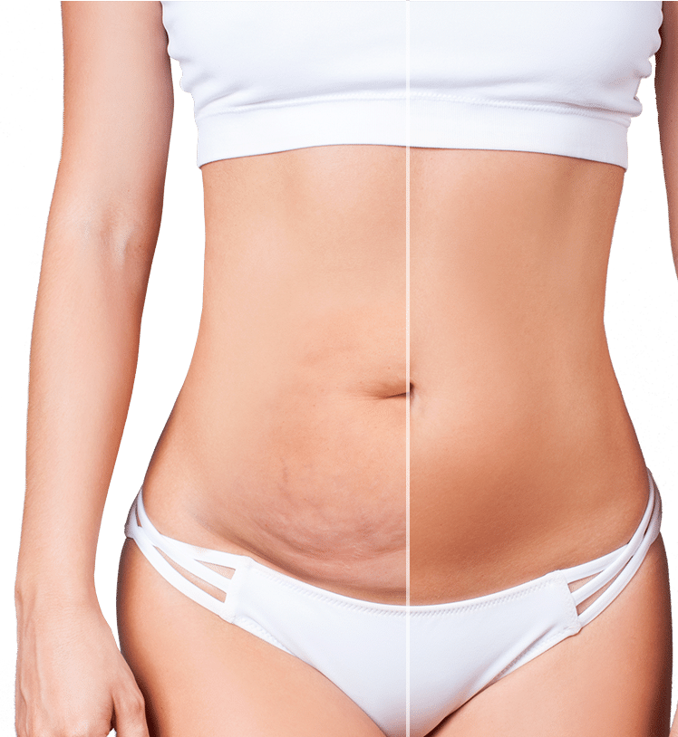 How Long is Recovery from a Tummy Tuck?