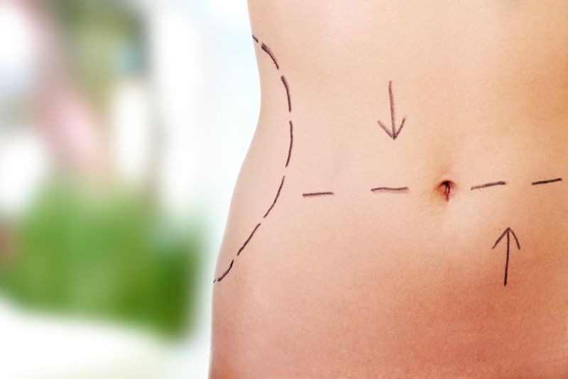 tummy tuck surgery