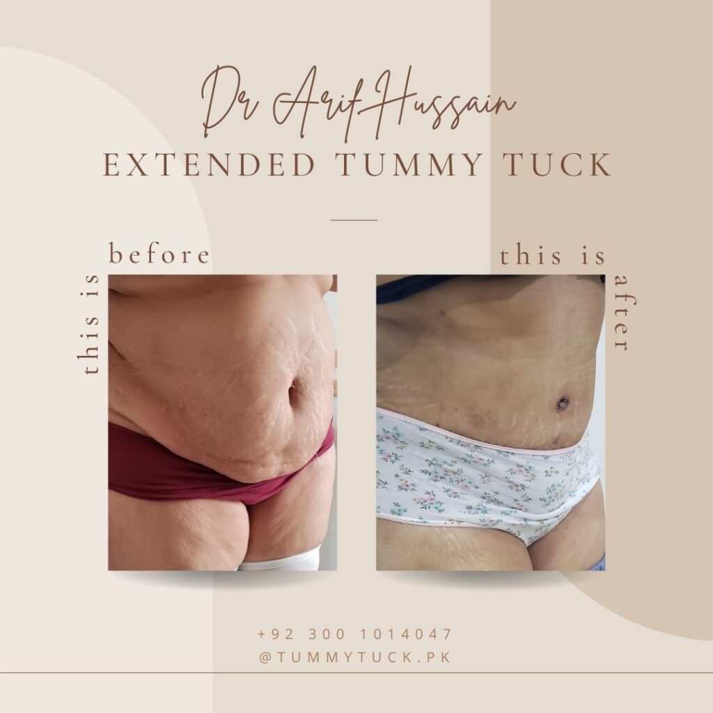 Extended Tummy tuck before and after